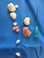 Chondromatose du coude