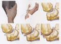 Rhizarthrose (arthrose du pouce)