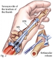 Tendinite du poignet (de quervain) - Dr Fontes Chirurgien de la Main  spécialisé dans le sport de haut niveau